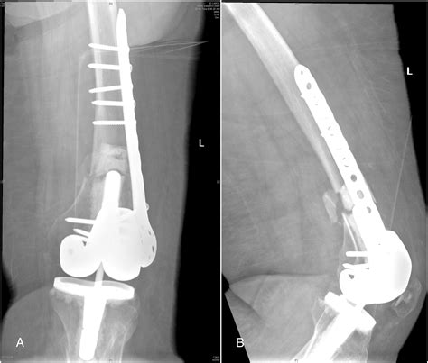High Complication Rate In Locking Plate Fixation Of Lower