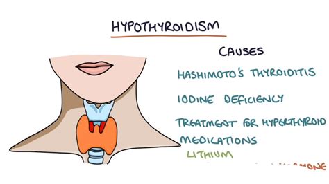 Read Hypothyroidism Underactive Thyroid By Pritish Kumar