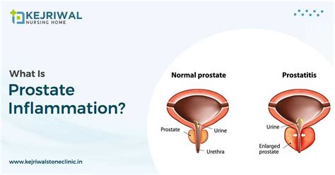Prostatitis Inflammation Of The Prostate Gland