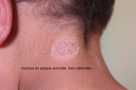 Dermato Info Les Mycoses Cutanées