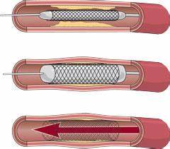 Стентирование - что это такое? Стентирование сосудов сердца: стоимость Картинка - Стентирование - что это такое? Стентирование сосудов сердца: стоимость