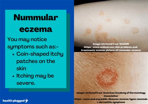 Types Of Eczema Symptoms Pictures Causes And Treatment