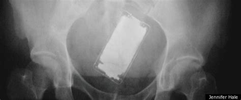 New Book Looks At X Rays Of Objects Stuck In Patients Orifices Photos