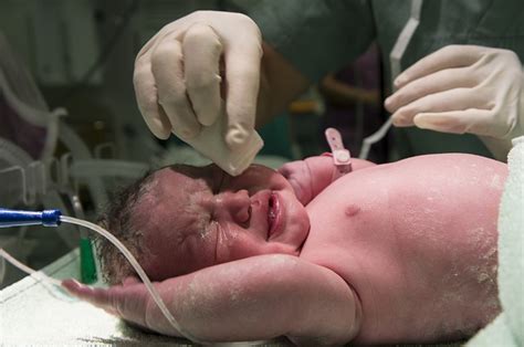 Neonatal Resuscitation — Procedure And Guidelines Lecturio