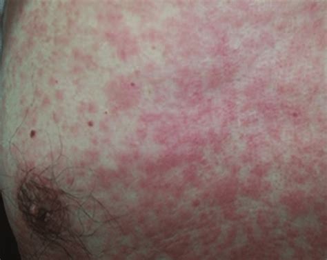 Maculopapular Rash On The Chest Induced By Intravitreal Aflibercept