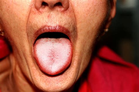 Najczęstsze Choroby Jamy Ustnej Przyczyny I Leczenie Porady W Interiapl