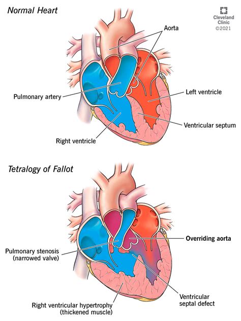 Overriding Aorta Symptoms Causes And Treatment