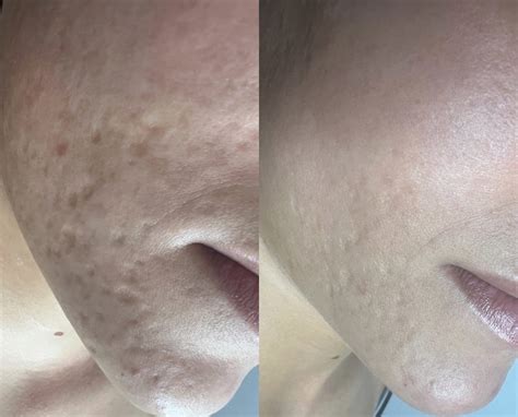 Fractional Co2 Laser Resurfacing The Norwich Face And Body Clinic