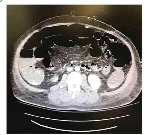 Ct Abdomen Revealing Air Fluid Levels With Dilation Of Multiple Loops