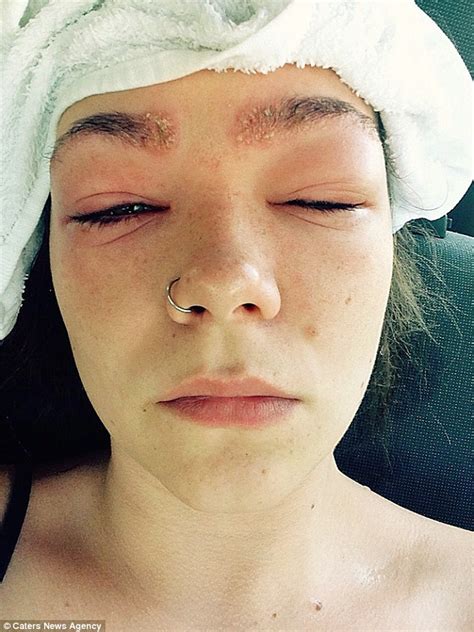 Victoria Woman Almost Goes Blind After Hair Dye Reaction Daily Mail