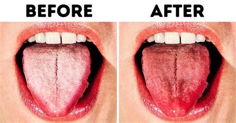 Why Your Tongue Turns White And 8 Ways To Get Rid Of It Bright Side