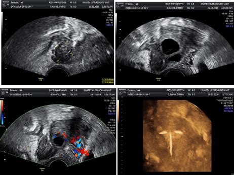 Tubo Ovarian Abscess Ultrasound Findings
