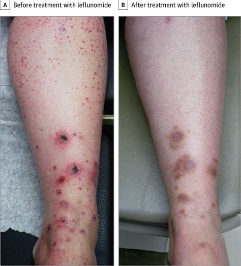 Successful Treatment Of Cutaneous Small Vessel Vasculitis With