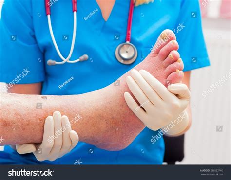 Dermatologist Examining Elderly Patients Arteriosclerotic Dry Leg