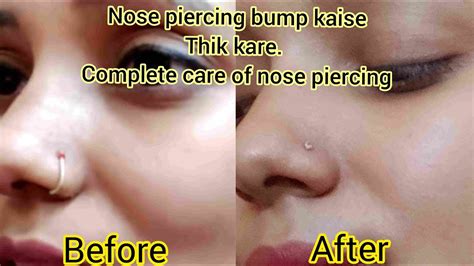How To Remove Nose Piercing Bumps Home Remedies To Remove Bump Get Rid Of Nose Piercing Bump