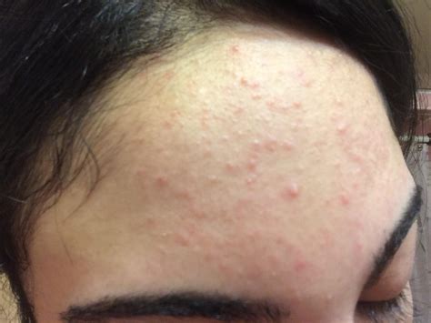What Are These Small Slightly Red Bumps On My Forehead General Acne