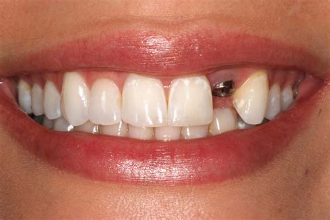 Implante Dentário Implantodontia Ortomix Odontologia Seu Dentista Em Brasília