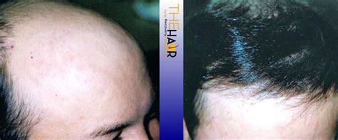 Gallery Hair Loss Recovery By Dr Larry Fremont
