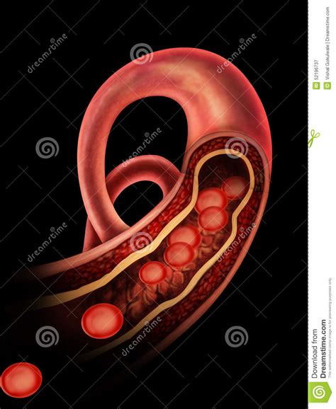 Anatomy Of Atherosclerosis In Artery Stock Illustration Illustration