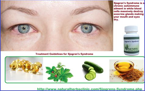 6 Natural Remedies For Sjogrens Syndrome Natural Herbs Clinic Blog