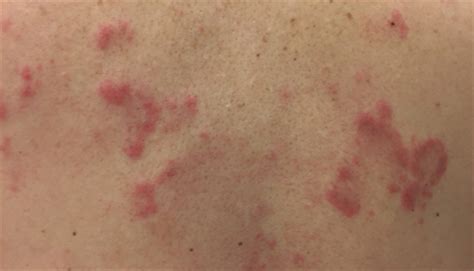 Erythematous Papules And Plaques Clinical Advisor