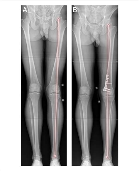A Standing Long Leg Radiograph Displaying Valgus Deformity Of The