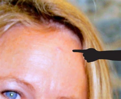 Basal Cell Carcinoma Forehead Hairline Basal Cell Carcinoma Skin