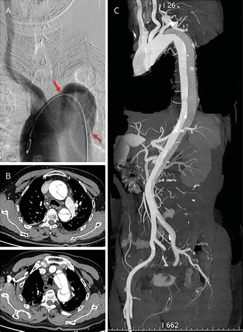 Figure Long Segmental Aortic Dissection Shown In Digital Subtraction