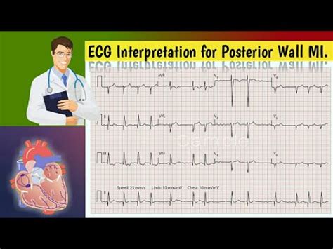 How To Look For Posterior Wall Mi On An Ecg Posterior Wall Mi Interpretation Youtube