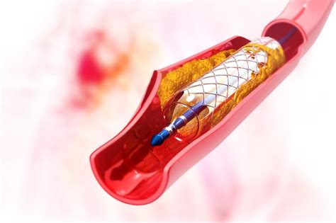 Angioplasty And Stents What You Need To Know
