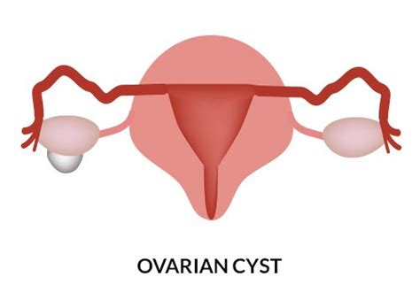 Enlarged Uterus Causes And Symptoms Of Enlarged Uterus