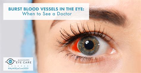 Burst Blood Vessels In The Eye When To See A Doctor Mississippi Eye Care