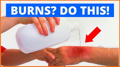 ⚠️ How To Treat Burns At Home First Aid For Burns And Scalds And Blisters Youtube