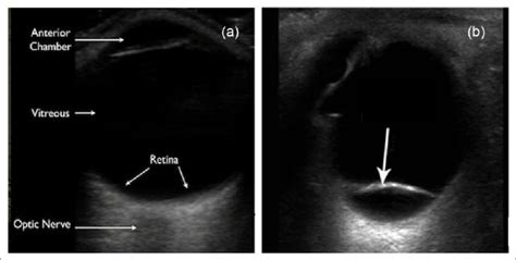A Ocular Ultrasound Of A Normal Eye Is Shown B A Retinal Flap