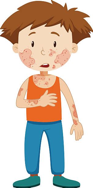 Royalty Free Skin Condition Clip Art Vector Images And Illustrations