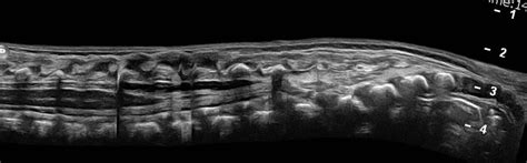 Neonatal Spine Ultrasound Anatomy