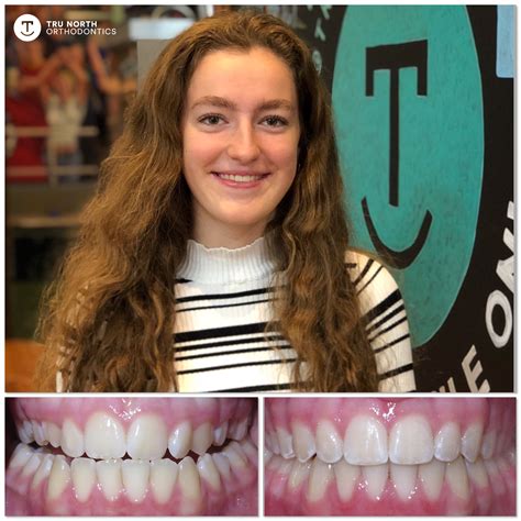 Radiant Smile Transformation At Tru North Orthodontics