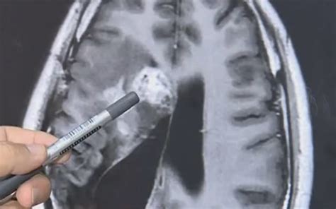 Flesh Eating 12cm Tapeworm Eats Mans Brain For 15 Years Viraltab
