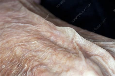 Reduced Turgor In Dehydrated Skin Stock Image C0111719 Science