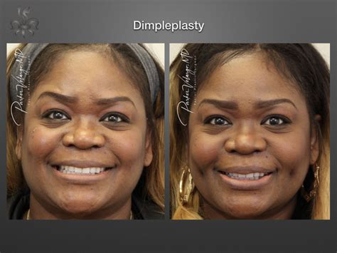 Dimpleplasty Case 3701 New Orleans Premier Center For Aesthetics And