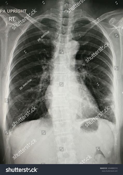 Chest Xray Decubitus Show Infiltration Right Foto Stock Hot Sex Picture