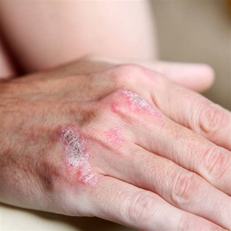 Can Psoriasis Be Cured The Natural Psoriasis Treatment Program