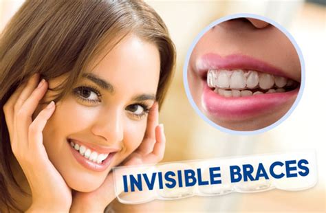 How Long Does It Take For Invisible Braces To Work How Does