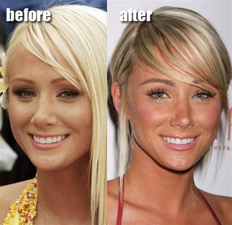 Celebrity Plastic Surgery Before After 56 Pics Izismile Com