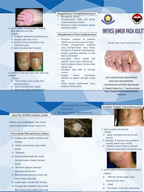 Infeksi Jamur Pada Kulit Leaflet Pdf