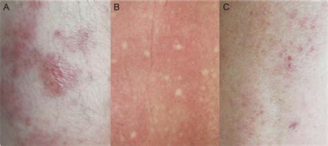 The presence of bumps, sores, lumps, colored areas or ulcers on the skin is referred to on the other hand, skin lesions that those moles that have changed in color, shape or size. Types of skin manifestations. (A) maculopapular lesions (B ...