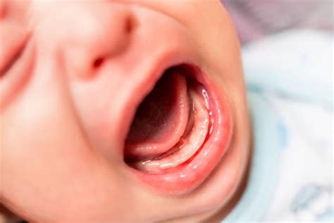 Como Fica A Gengiva Quando Vai Nascer Dente