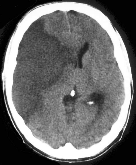 Acute Infarct Radiology At St Vincents University Hospital