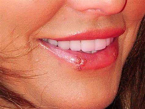 Cold Sore What It Is How To Get Rid Of It And The Causes