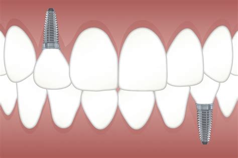 The Procedure Of Placing Dental Implants